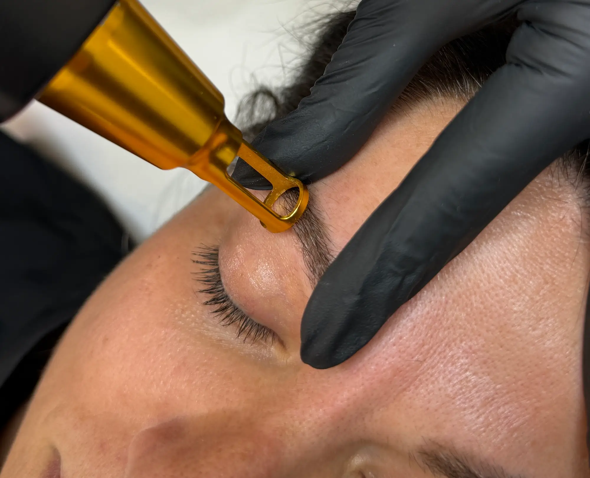 micropigmentacion Primer plano de una persona acostada con los ojos cerrados, recibiendo despigmentación con láser en la zona de las cejas. Una mano enguantada sostiene un dispositivo dorado, aplicando hábilmente el tratamiento para perfeccionar las cejas. Monica Aranguez