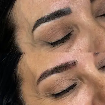 micropigmentacion El primer plano del ojo cerrado de una mujer muestra las cejas antes y después de la despigmentación con láser de tatuajes y micropigmentación: la imagen superior muestra una ceja gruesa y de aspecto artificial, mientras que la inferior revela un resultado más natural y bien formado. Monica Aranguez