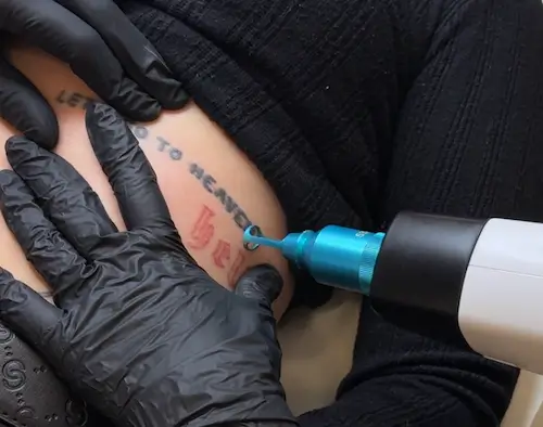 micropigmentacion Primer plano de un procedimiento de eliminación de tatuajes en el costado de una persona. El profesional, con guantes negros, utiliza un láser azul para la despigmentación, dirigido al tatuaje que parcialmente dice "LET TO HEVEN". Monica Aranguez