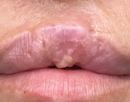 micropigmentacion Primer plano de los labios de una persona que presenta una lesión o textura anormal en el labio superior, que posiblemente requiera micropigmentación o procedimientos reconstructivos. La piel alrededor de los labios se ve ligeramente inflamada y con una textura irregular. Monica Aranguez