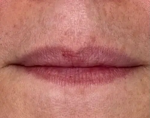 micropigmentacion Primer plano de los labios de una persona después de la micropigmentación en labios, que muestra una grieta roja visible o una llaga en el centro del labio superior, rodeada de piel ligeramente texturizada. Monica Aranguez