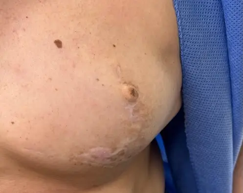 micropigmentacion Un primer plano del pecho de una persona revela un pequeño lunar y una cicatriz cerca de la areola. Vestida con una prenda azul, la piel de la persona presenta tonos ligeramente desiguales. Monica Aranguez