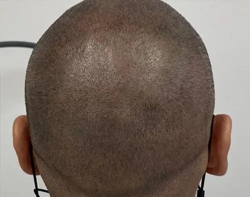 micropigmentacion Primer plano de la nuca de un hombre con un corte de pelo rapado muy corto, lo que sugiere una micropigmentación reciente. El cuero cabelludo muestra una sombra de crecimiento del cabello. Lleva gafas negras finas, con las patillas visibles alrededor de las orejas. Monica Aranguez
