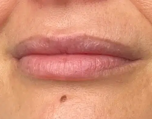 micropigmentacion Primer plano de los labios y la piel circundante de una persona con un pequeño lunar elevado justo debajo del labio inferior. Los labios están cerrados, tienen un aspecto natural y parecen intactos tras la micropigmentación en labios. Monica Aranguez