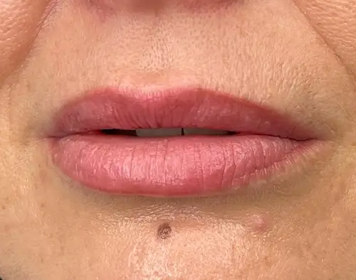 micropigmentacion Primer plano de los labios y el mentón de una persona, mostrando las líneas labiales naturales con micropigmentación labial, un lunar debajo del labio inferior y un pequeño grano junto al lunar en el mentón. Se aprecian la textura de la piel y ligeras arrugas. Monica Aranguez