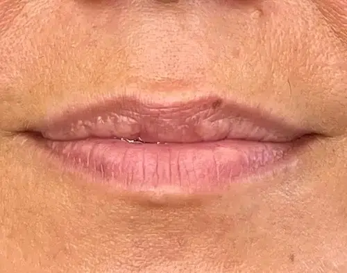 micropigmentacion Primer plano de los labios de una persona, que revela una textura agrietada e irregular. El labio superior presenta una pequeña imperfección cerca del centro; considere la micropigmentación labial para lograr una apariencia más suave. El tono de piel es cálido y ligeramente texturizado, resaltando los matices naturales. Monica Aranguez