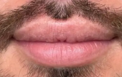 micropigmentacion Primer plano de los labios de una persona y parte de su bigote y barba, mostrando los resultados de los tratamientos de micropigmentación para hombres. Los labios están ligeramente curvados, el vello facial es corto y bien cuidado, lo que complementa a la perfección el tono de piel claro. Monica Aranguez