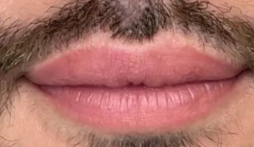 micropigmentacion Primer plano de la boca de una persona con bigote y barba cortos, que resalta detalles del vello facial y el tono de piel. Esta imagen captura los resultados potenciales de la micropigmentación masculina, realzando cada rasgo con precisión. Monica Aranguez